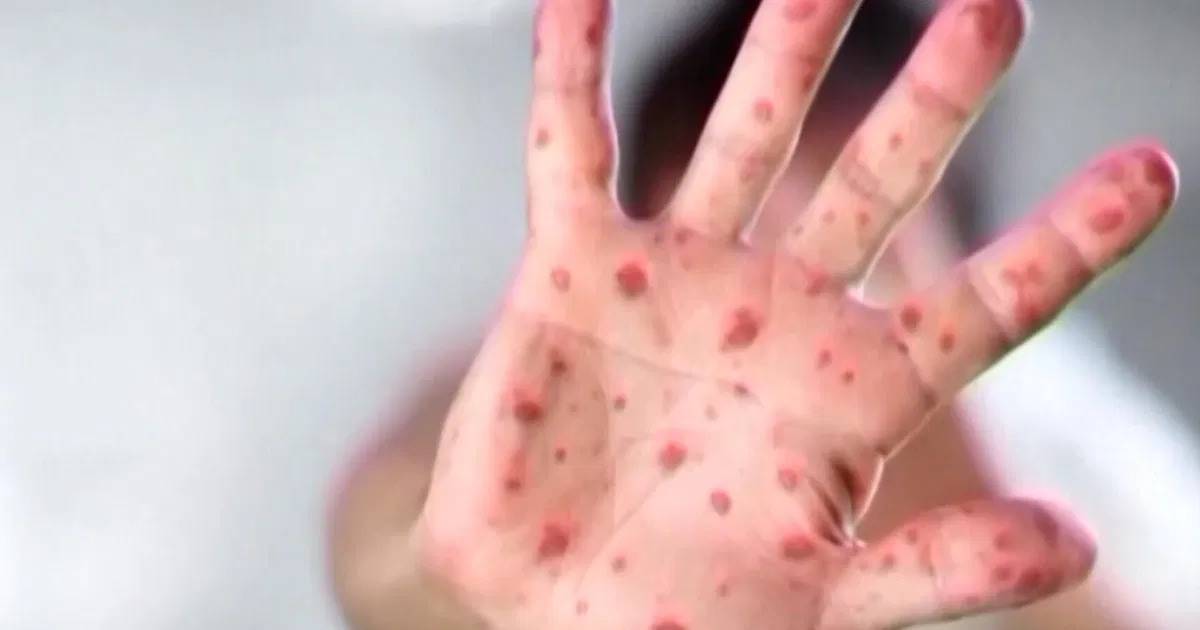 The measles vaccine is required in NC schools. Here's what to know